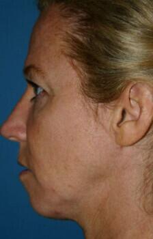 Facelift Before & After Image