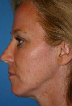 Facelift Before & After Image