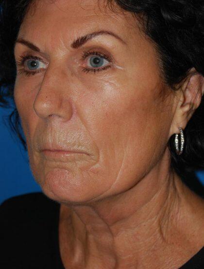 Facelift Before & After Image