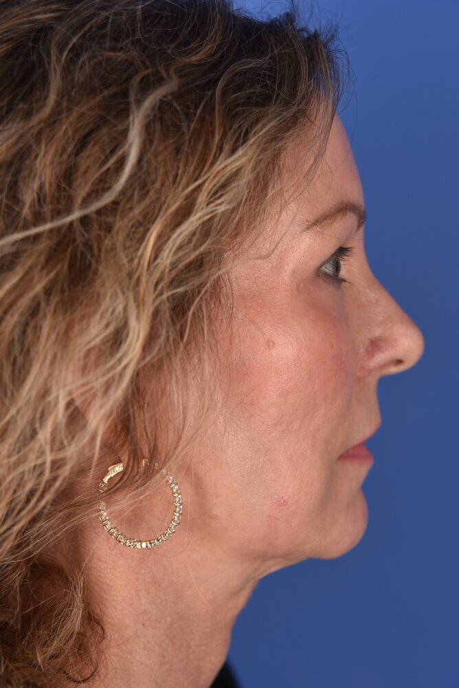 Facelift Before & After Image