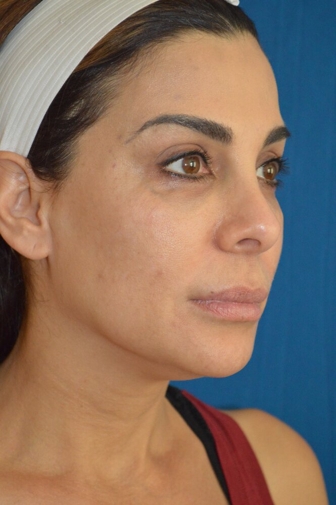 Facelift Before & After Image