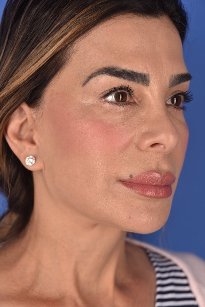Facelift Before & After Image