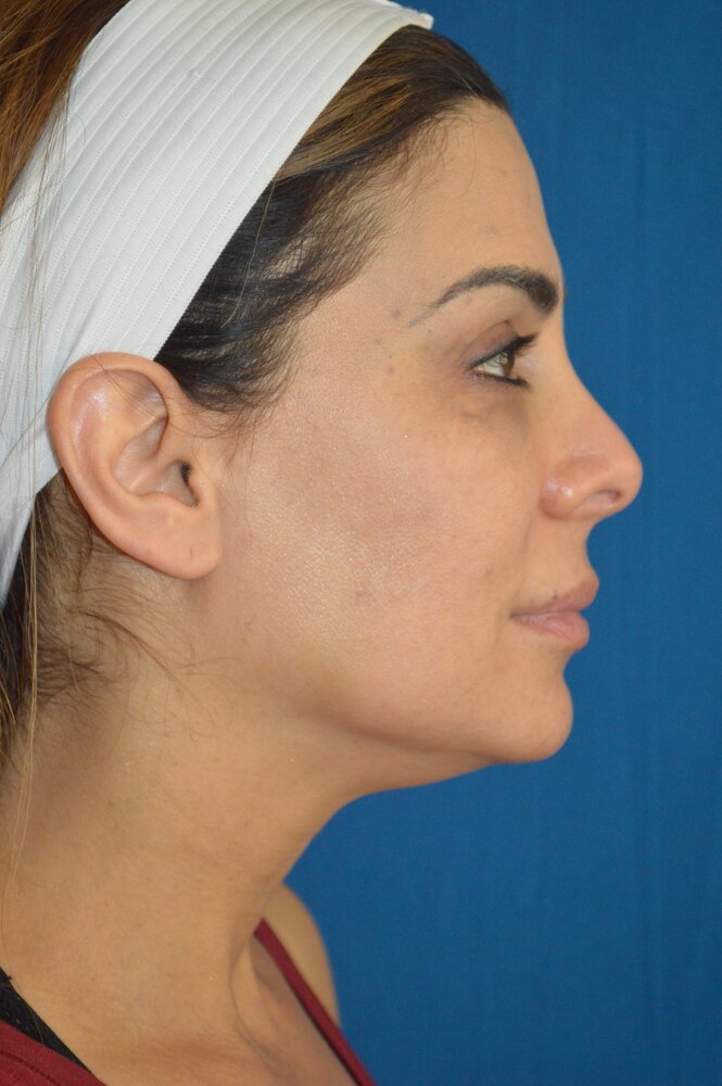 Facelift Before & After Image