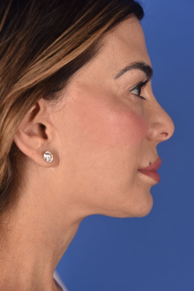 Facelift Before & After Image