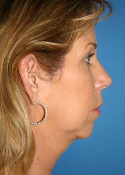 Facial Implants Before & After Image