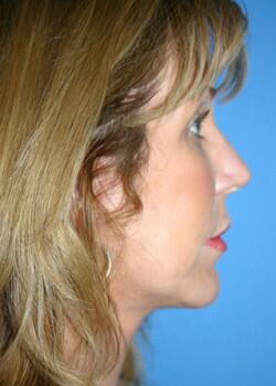 Facial Implants Before & After Image