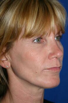 Facial Implants Before & After Image