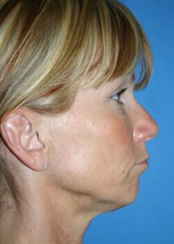 Facial Implants Before & After Image