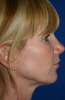 Facial Implants Before & After Image