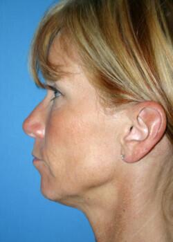 Facial Implants Before & After Image