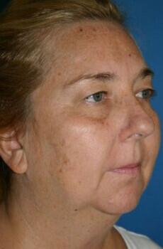 Facial Implants Before & After Image