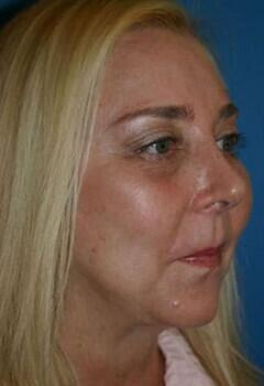 Facial Implants Before & After Image