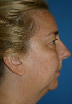 Facial Implants Before & After Image