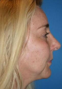 Facial Implants Before & After Image