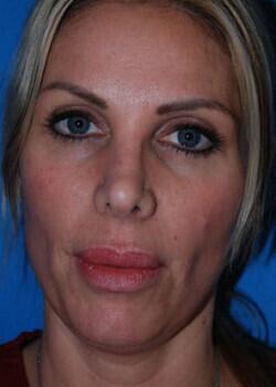 Facial Implants Before & After Image