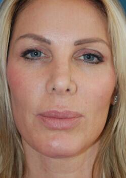 Facial Implants Before & After Image