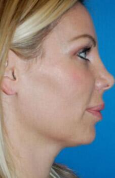 Facial Implants Before & After Image