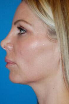 Facial Implants Before & After Image