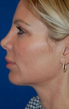 Facial Implants Before & After Image