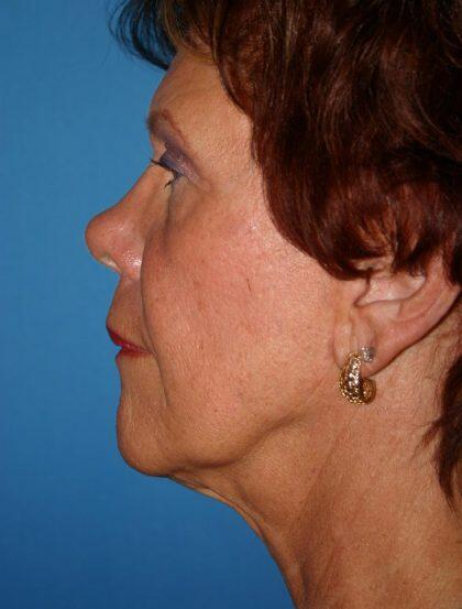 Neck Lift Before & After Image