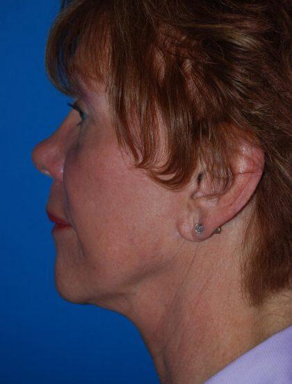 Neck Lift Before & After Image