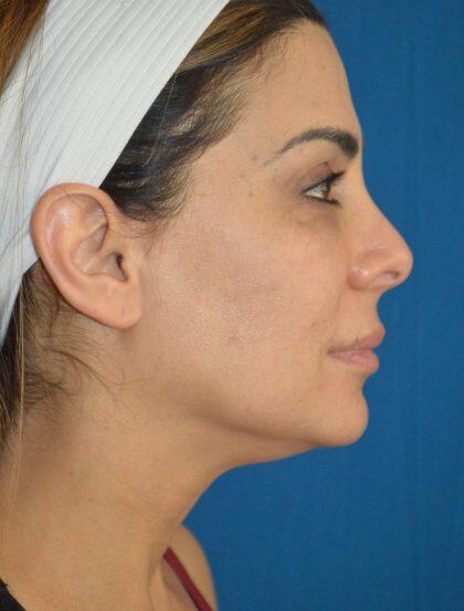 Neck Lift Before & After Image