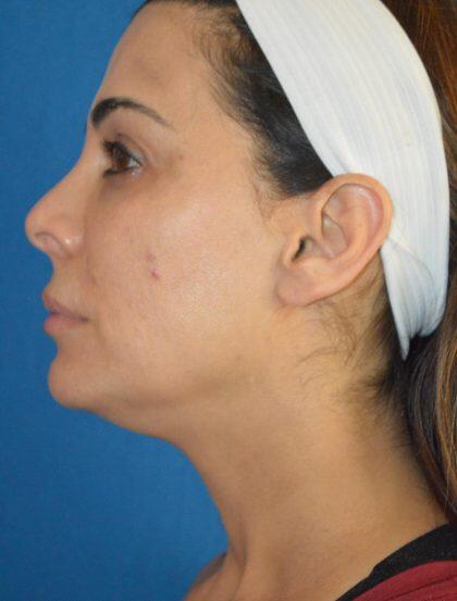 Neck Lift Before & After Image