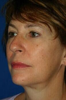 Neck Lift Before & After Image