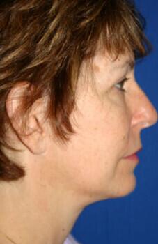 Neck Lift Before & After Image