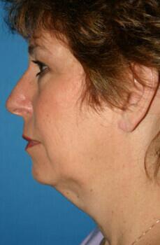 Neck Lift Before & After Image