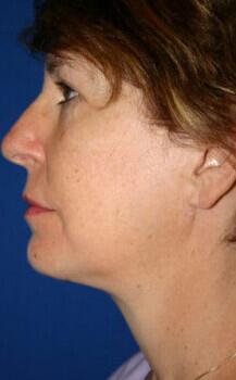 Neck Lift Before & After Image