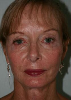 Neck Lift Before & After Image