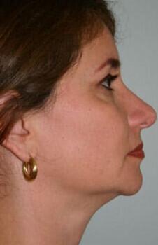 Neck Lift Before & After Image