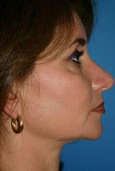 Neck Lift Before & After Image