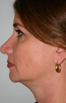 Neck Lift Before & After Image