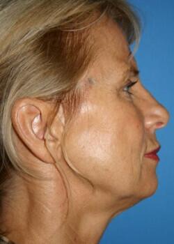 Neck Lift Before & After Image