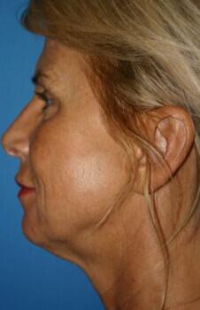 Neck Lift Before & After Image