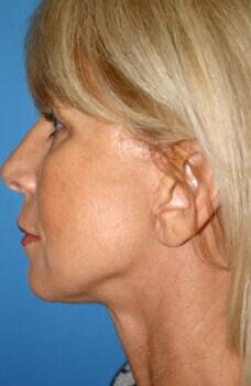 Neck Lift Before & After Image