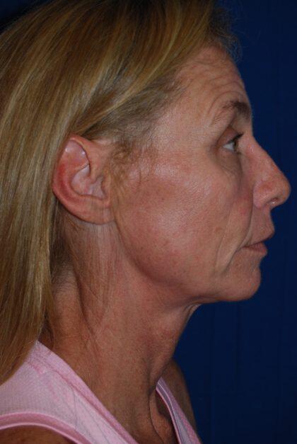 Neck Lift Before & After Image