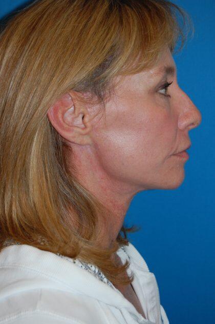 Neck Lift Before & After Image