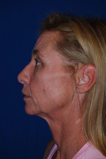 Neck Lift Before & After Image