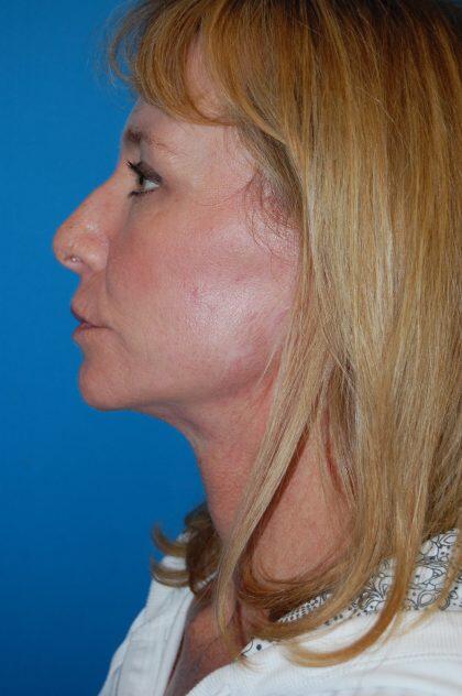 Neck Lift Before & After Image