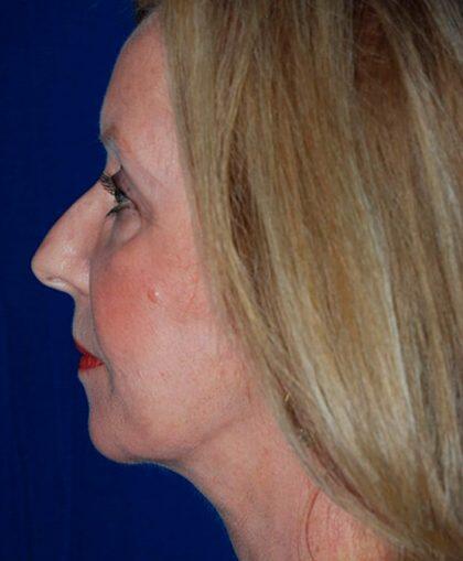 Neck Lift Before & After Image