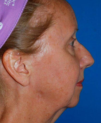 Neck Lift Before & After Image