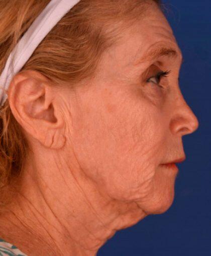 Neck Lift Before & After Image