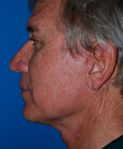 Neck Lift Before & After Image