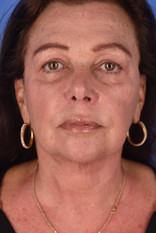 Neck Lift Before & After Image