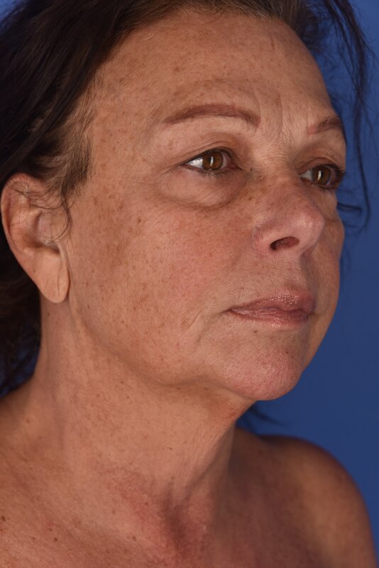 Neck Lift Before & After Image