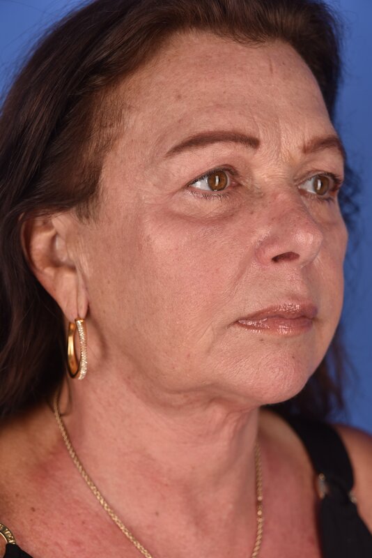 Neck Lift Before & After Image