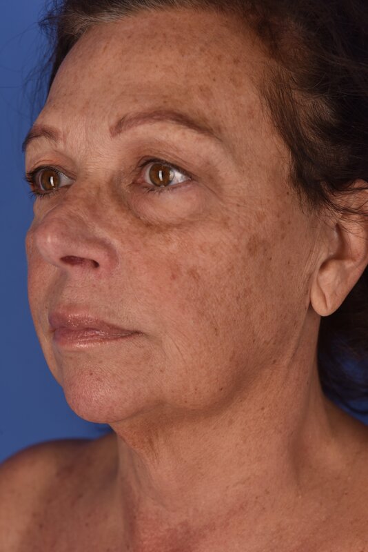 Neck Lift Before & After Image